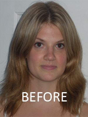 Test subject from front before the treatment